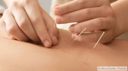 Akupunktur und Akupressur – Wie traditionelle chinesische Medizin (TCM) gegen Schnarchen hilft