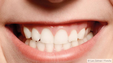Bruxismus – Was tun gegen Zähneknirschen?