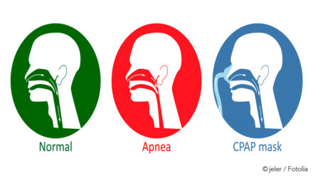 Was tun, wenn die CPAP-Maske pfeift? Unsere Tipps gegen CPAP Maskenleckagen!