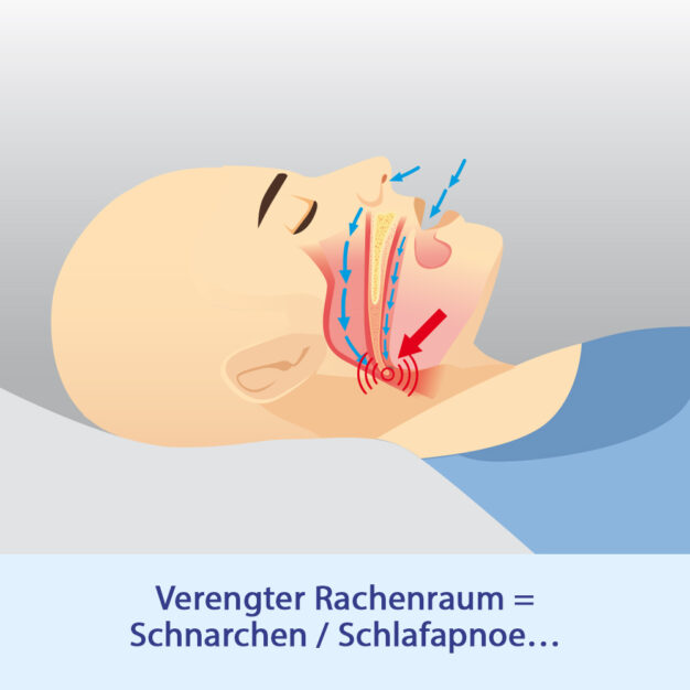 Verengter Rachenraum sorgt für Schnarchen