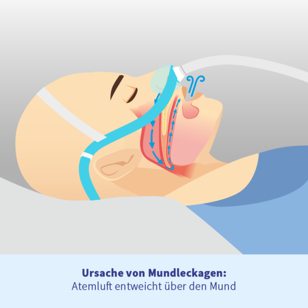 oxyhero CPAP pro Schildschiene gegen Mundleckagen 02